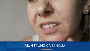 Mụn trứng cá bị ngứa: Bí quyết giảm ngứa rát do mụn trứng cá