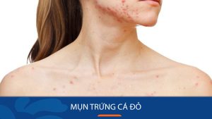 Bí Quyết Giải Quyết Mụn Trứng Cá Đỏ Hiệu Quả 100%