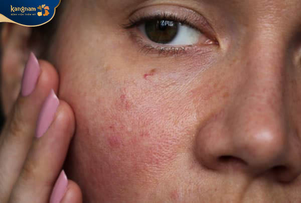 Do nền da bị thoái hóa