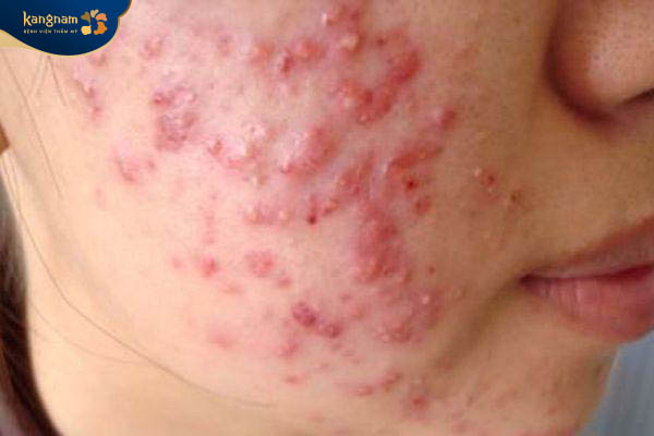 Mụn trứng cá đỏ do nhiều nguyên nhân khác nhau