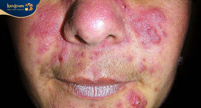 Mụn trứng cá ở mũi