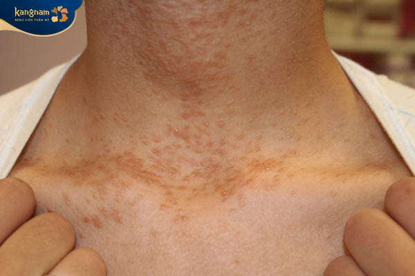 Mụn trứng cá ở cổ do nội tiết thay đổi