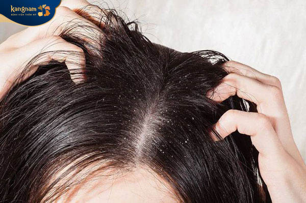 Lười gội đầu cũng là nguyên nhân hình thành mụn trứng cá