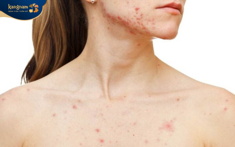 Mụn trứng cá mọc ở cổ không nguy hiểm nhưng có thể phát triển nặng nếu không được sớm điều trị
