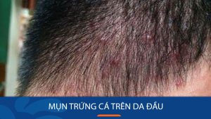 Mụn trứng cá trên da đầu: Nguyên nhân, triệu chứng và cách điều trị hiệu quả
