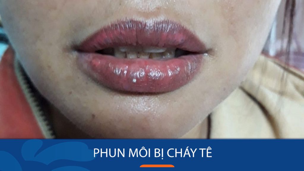 Phun Môi Bị Cháy Tê: Nguyên nhân & Cách xử lý an toàn