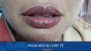 Phun Môi Bị Cháy Tê: Nguyên nhân & Cách xử lý an toàn