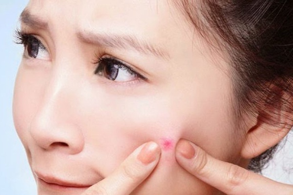 tránh nặn mụn