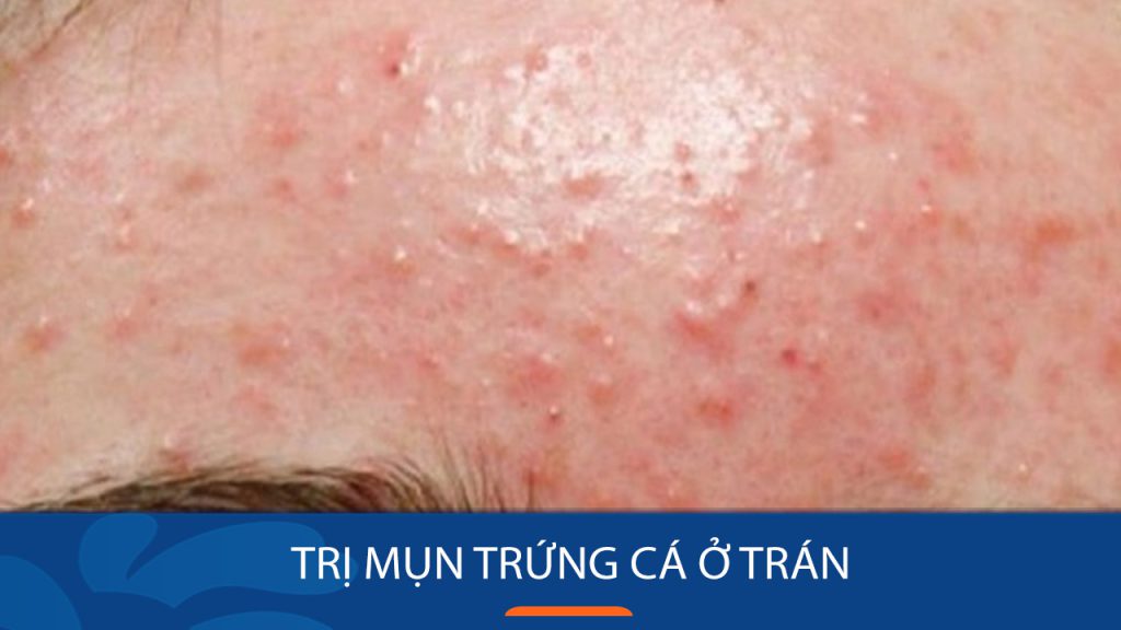 Bí quyết đánh bay mụn trứng cá ở trán hiệu quả