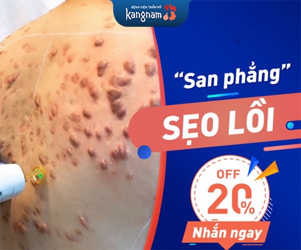 trị sẹo công nghệ ella