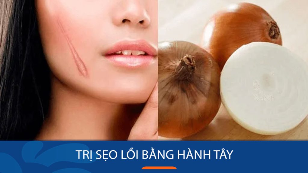 5 Cách Trị Sẹo Lồi Bằng Hành Tây Hiệu Quả Tại Nhà
