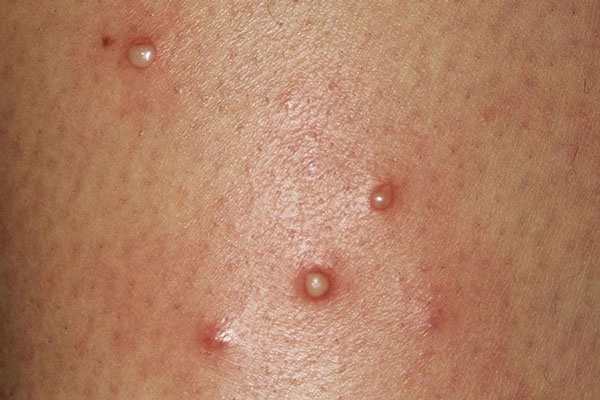 Vi khuẩn tấn công vào nang lông cũng gây ngứa ngáy