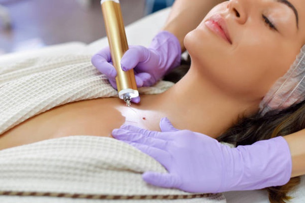 xóa nốt ruồi yết hầu