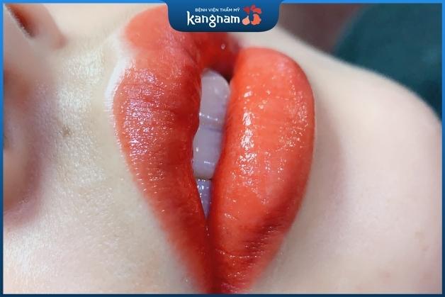 Kết quả phun môi Plascell