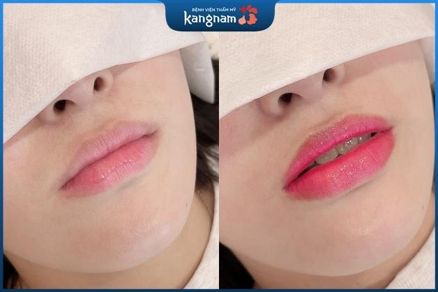 Phun xăm Plascell - Môi hồngcăng mọng