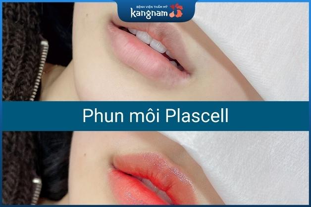 Phun xăm Plascell tại BV Kangnam