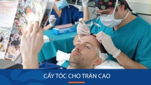 Cấy tóc cho trán cao: Bí quyết xóa sổ hói, dô chỉ sau 1 lần chữa