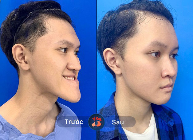 Anh Tuấn sau phẫu thuật