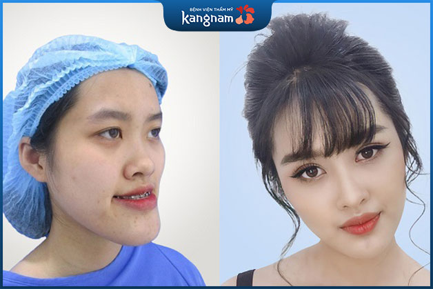 Chị Hạnh sau phẫu thuật