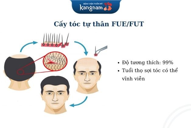 Cấy tóc cho trán cao bằng tự thân
