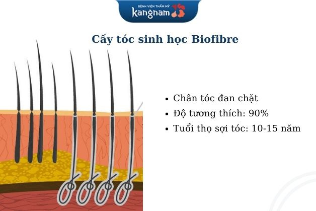 Cấy tóc sinh học cho trán cao