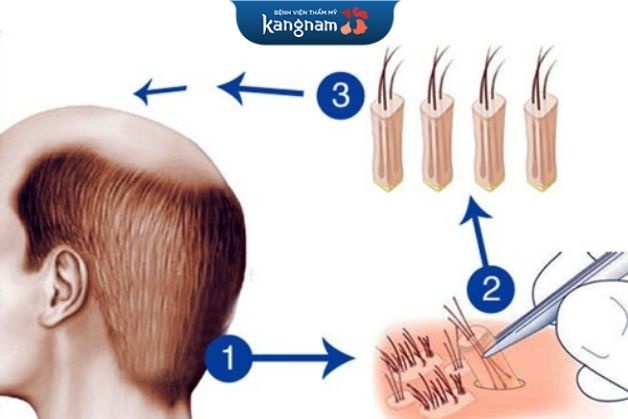 Cấy tóc tự thân có độ tương thích cao