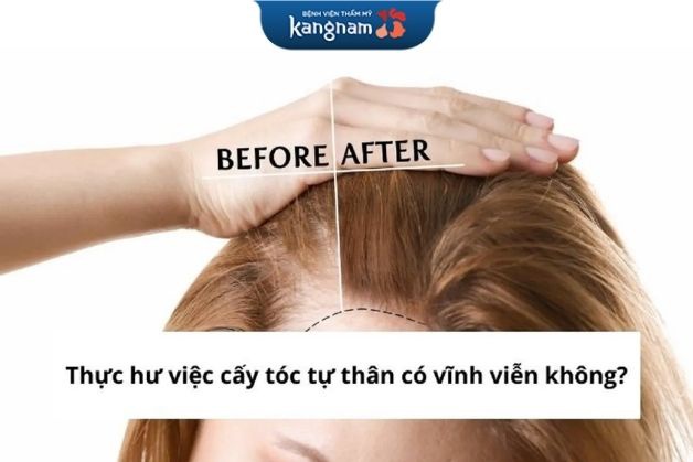 Cấy tóc tự thân có vĩnh viễn không?