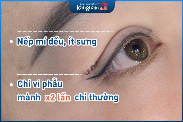 Sử dụng chỉ vi phẫu siêu mảnh