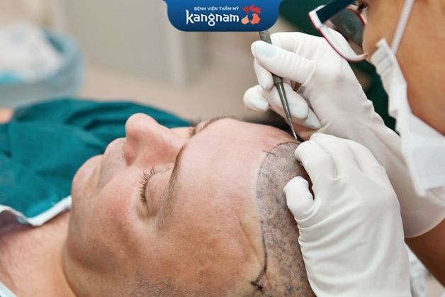 Chọn bác sĩ cấy tóc chuẩn Cấy tóc có được vĩnh viễn không