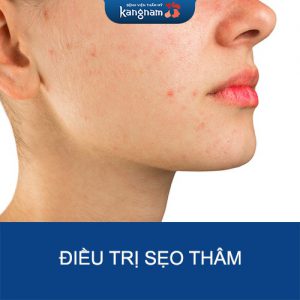 Mách nhỏ 9 cách điều trị sẹo thâm đơn giản tại nhà