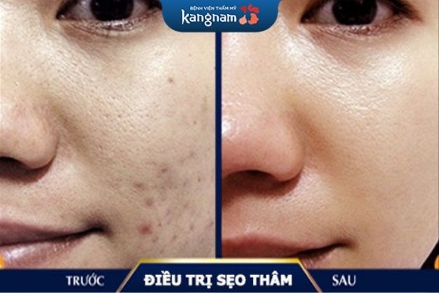 Khách hàng điều trị sẹo thâm tại Kangnam