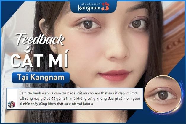 Feedback của khách hàng cắt mí tại Kangnam