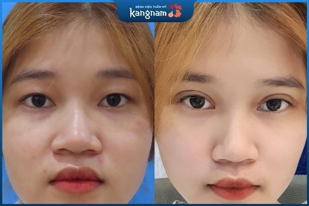 Nếp mí nhìn rất tự nhiên và không để lại sẹo