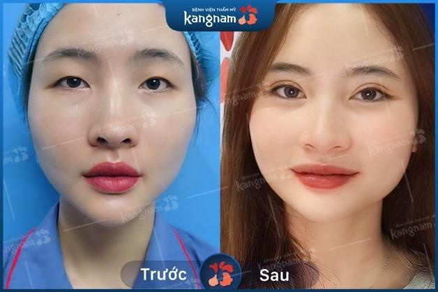 Hết mắt 1 mí, mắt 2 mí to tròn sau khi Cắt mí 6D