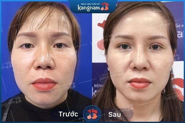 Mắt 2 mí trẻ trung hơn 5 tuổi