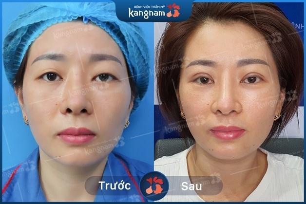 Đôi mắt cân đối, trẻ trung hơn sau Cắt mí 6D
