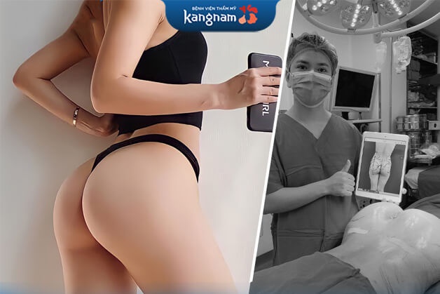 Chị Vân review ảnh hưởng sau khi nâng mông