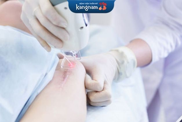 Làm phẳng sẹo bằng laser