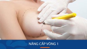 Nâng cấp vòng 1 như thế nào? Trường hợp nào cần thực hiện