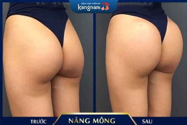 Nâng mông thành công phụ thuộc nhiều vào tay nghề bác sĩ