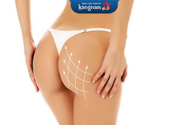 Nâng mông được bao lâu do công nghệ