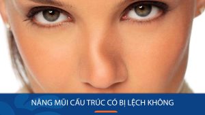 Nâng mũi cấu trúc có bị lệch không? Nguyên nhân & cách hạn chế