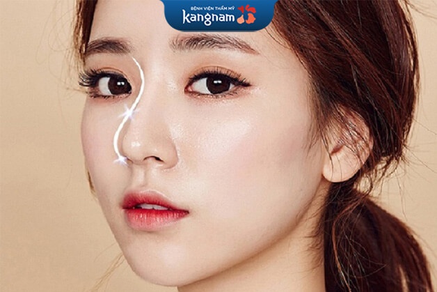 Nâng mũi s line có được vĩnh viễn không