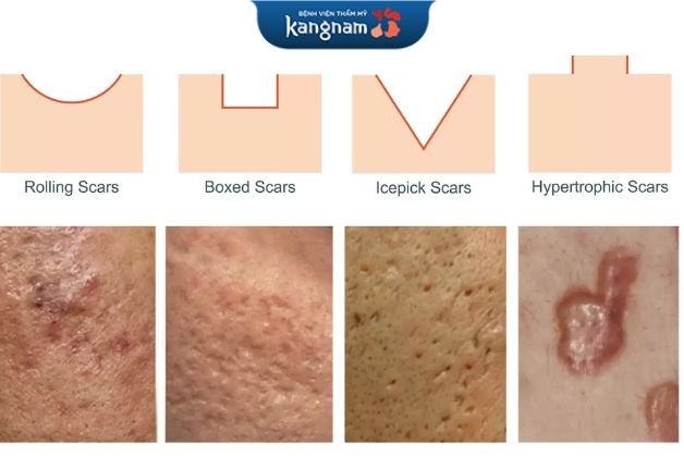 Sẹo mụn có nhiều dạng khác nhau