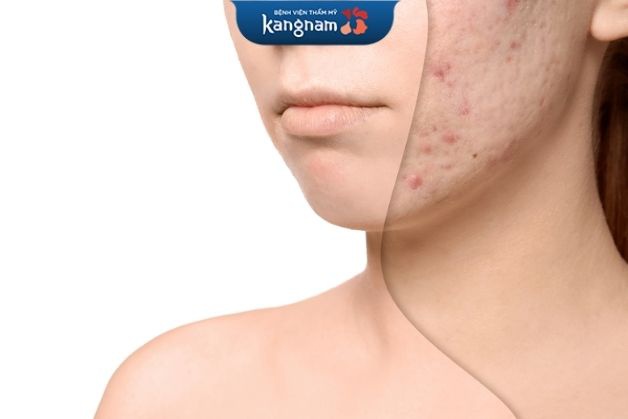 Sẹo mụn do nhiều nguyên nhân