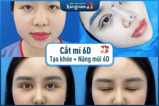 Khách hàng làm combo cắt mí và nâng mũi 6D tại Kangnam