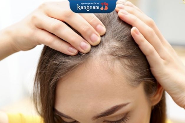 Thay đổi nội tiết làm rụng tóc nhiều