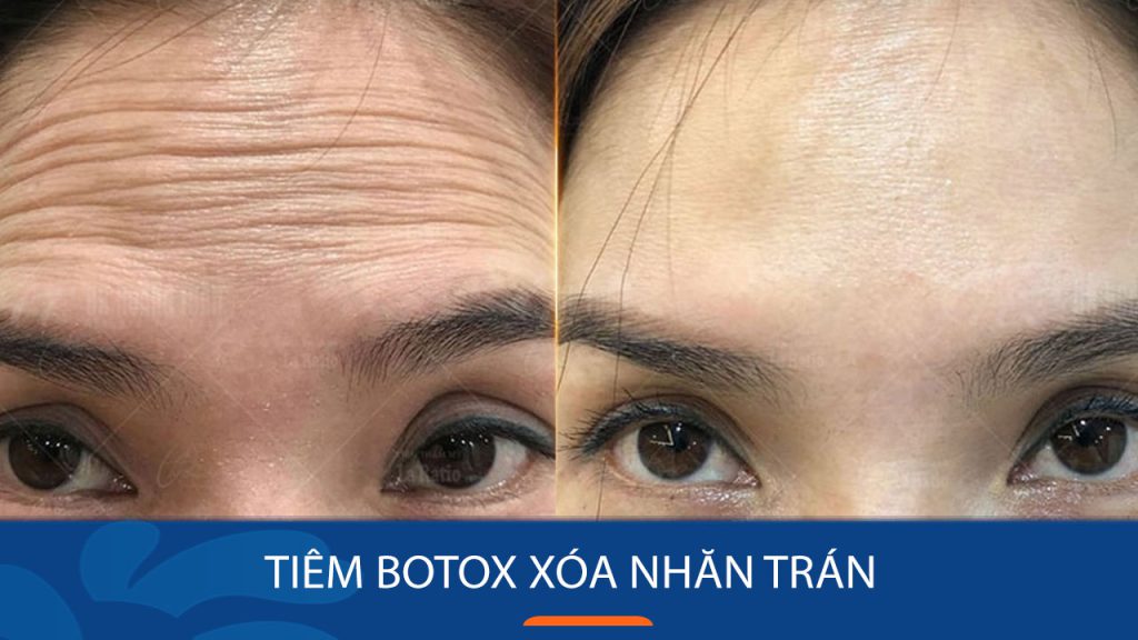 Tiêm botox xóa nhăn trán: Giải đáp tất tần tật các thắc mắc phổ biến