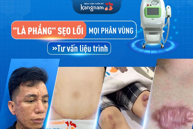 Trị sẹo bằng laser tại kangnam