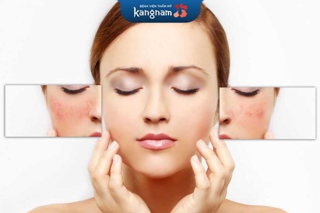 Trị sẹo collagen khá hiệu quả